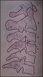 Backward Subluxation