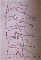Forward Subluxation