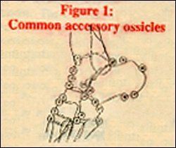 accessory ossicle