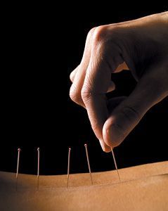 acupuncture on back