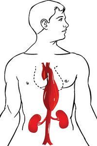 Aortic Aneurysm