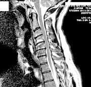 MRI study taken a year before the chair incident.