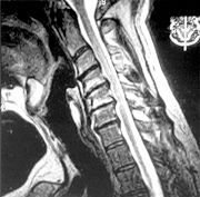 MRI study obtained after the chair incident.