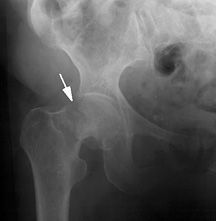 neck of femur fracture