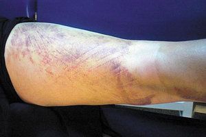 lymphatic taping