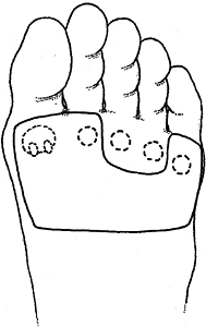 Interdigital Neuritis