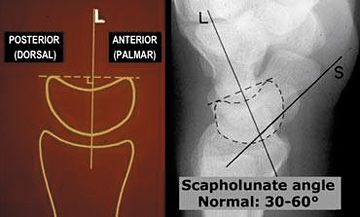 Axis of the lunate