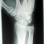 trapezio-trapoidal joint
