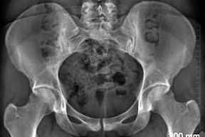 bilateral retroverted acetabula