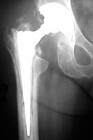 stem of the femoral component