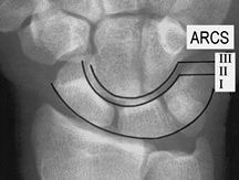 The carpal arcs