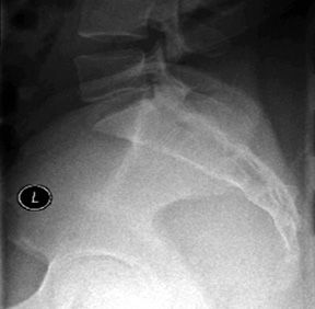 Lateral view of the sacrum and coccyx