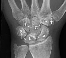 The carpal bones