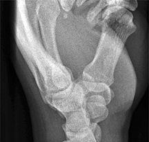 Lateral view of the wrist
