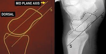 Axis of the scaphoid