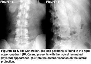 CT of thoracic lymph nodes. Part I:.