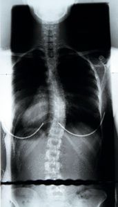 scoliosis spine xray