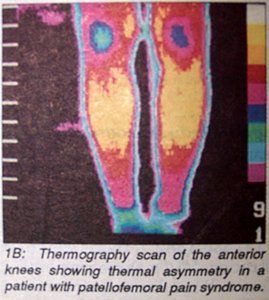 Thermography scan of the anoterior knees 2 - Copyright – Stock Photo / Register Mark