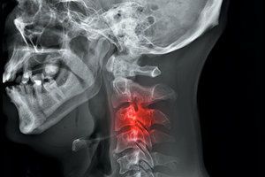 the struggle to heal the cervical syndrome exploring challenges and