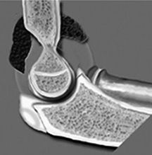 The Pediatric Elbow: A Review of Fractures head ulna diagram 