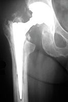 stem of the femoral component - Copyright – Stock Photo / Register Mark