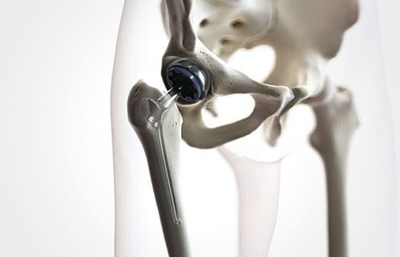 hip replacement